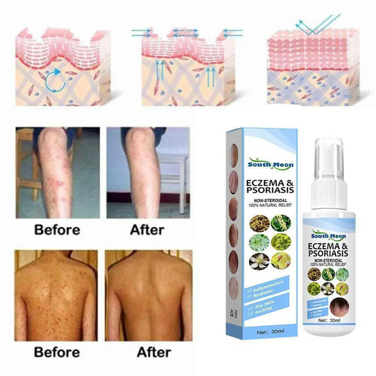 Herbal Psoriasis Relief Spray Everrd