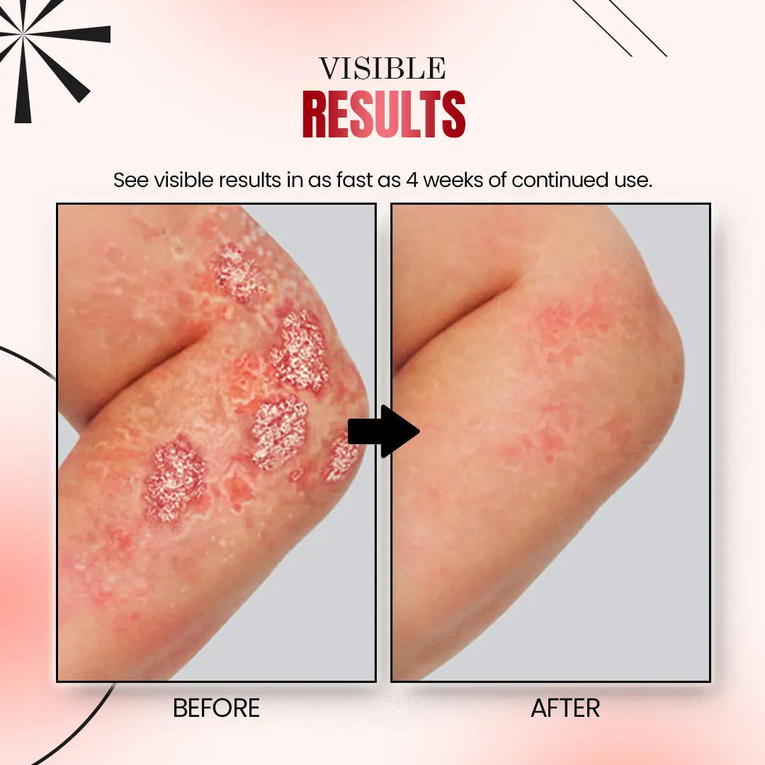 Psoriatrax Psoriasis Relief Spray - EVERRD USA