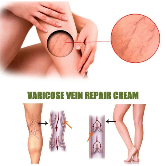 MEDix™ Varicose Veins Spray - EVERRD USA