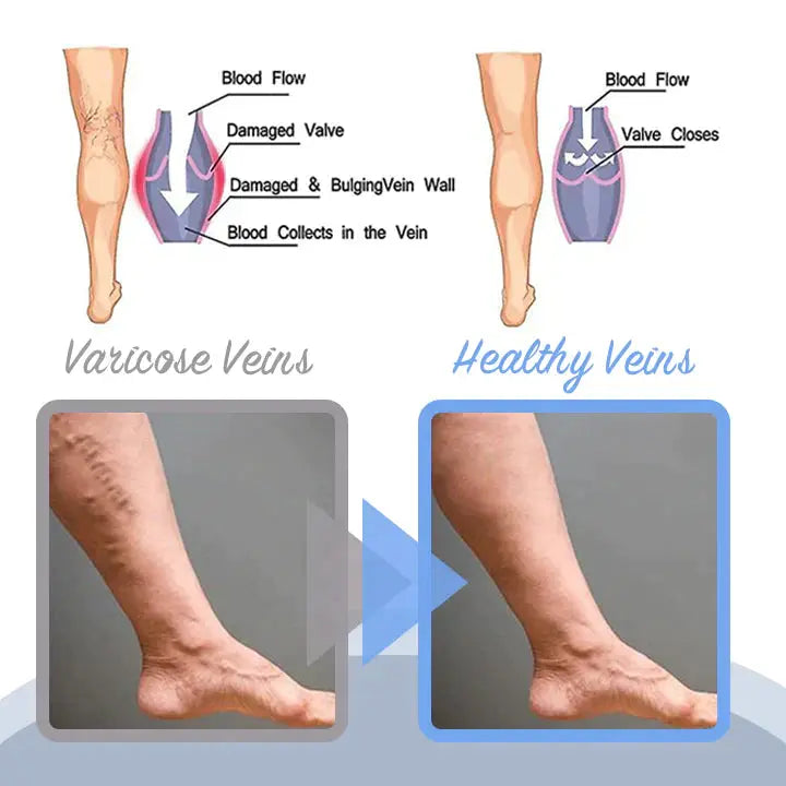 MEDix™ Varicose Veins Spray - EVERRD USA