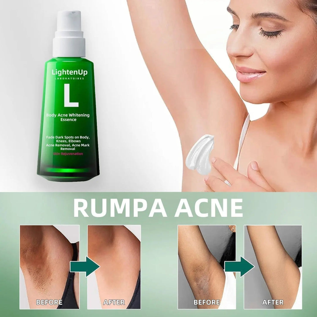 LightenUp™ Body Acne Serum(for Acne & Spots & Acanthosis Nigricans Removal) - EVERRD USA