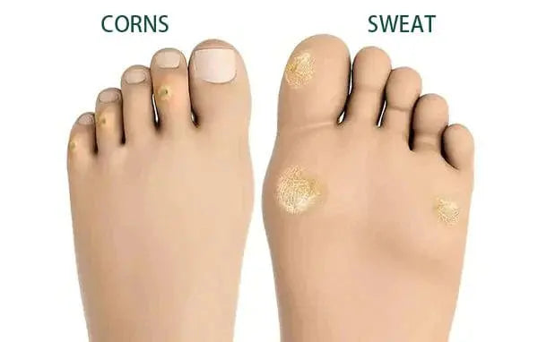 FootPro Corn Removal Extra Strengthen Gel - EVERRD USA