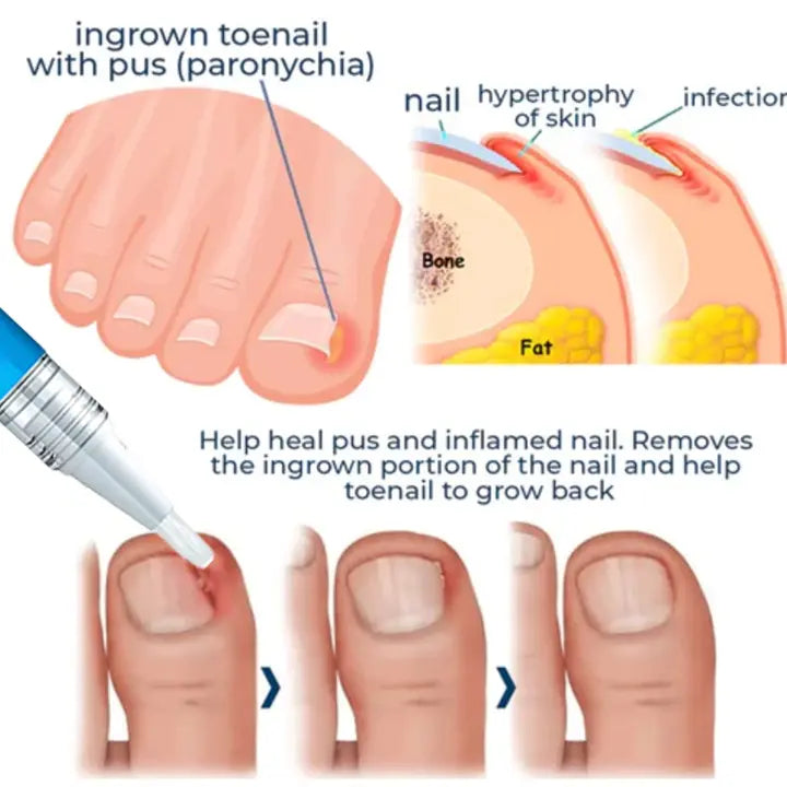 Oveallgo™ PRO Removal Paronychia Gel - EVERRD USA