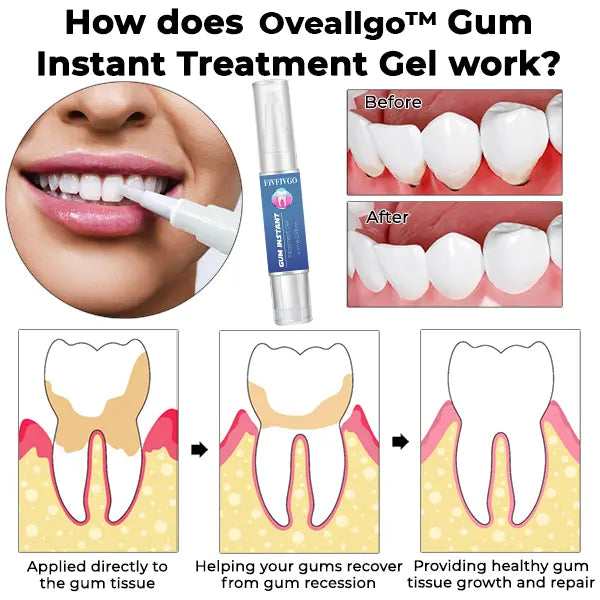 Oveallgo™ Gum Instant Treatment Gel - EVERRD USA