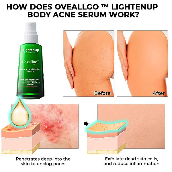 Oveallgo™ LightenUp Body Acne Serum (for Acne & Spots & Acanthosis Nigricans Removal) - EVERRD USA