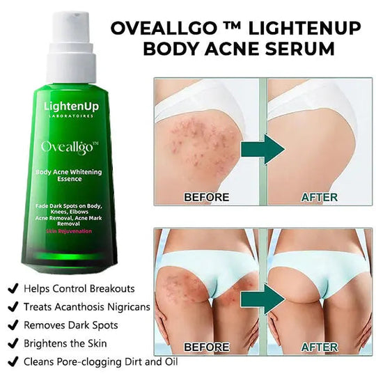 Oveallgo™ LightenUp Body Acne Serum (for Acne & Spots & Acanthosis Nigricans Removal) - EVERRD USA