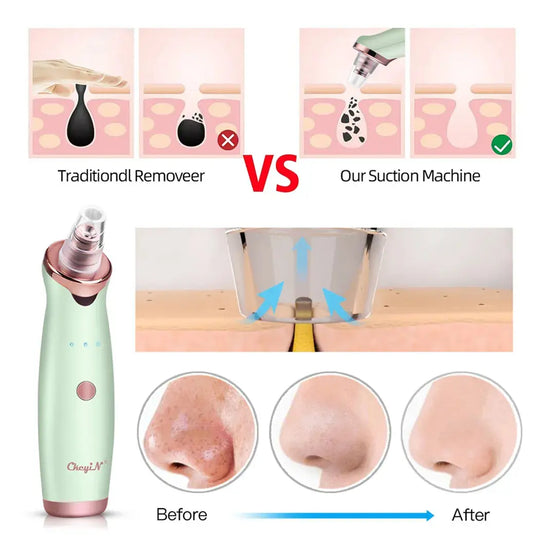 Everrd™ Electric Blackhead Remover - EVERRD USA