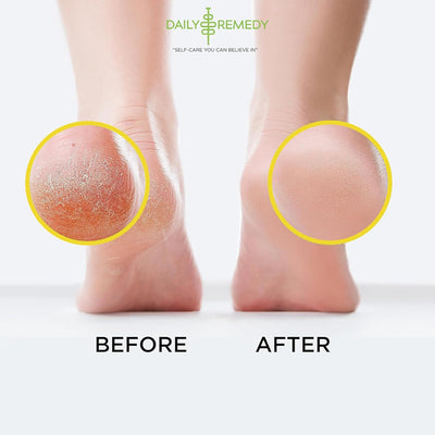 Citrus Detox Foot Soak with Epsom Salt - Pack of 2 - Removes Foot Callus, Boost Immune, Helps Treat Athletes Foot, Inflammation, Tired, Aching Feet and Toenail Inflammation