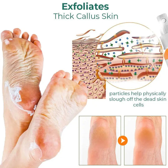 GFOUK™ Foot Callus Removal Spray - EVERRD USA