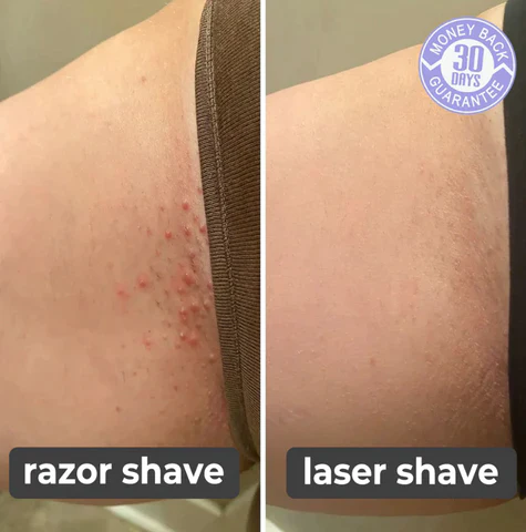 Laser Hair Remover 2.0 - EVERRD USA